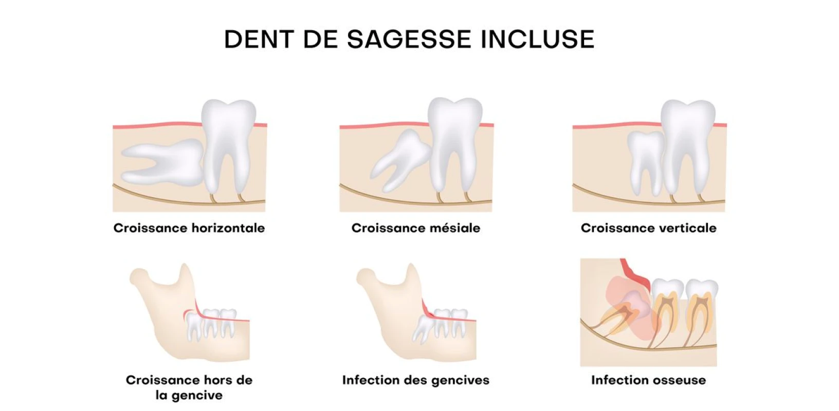 Les dents de sagesse